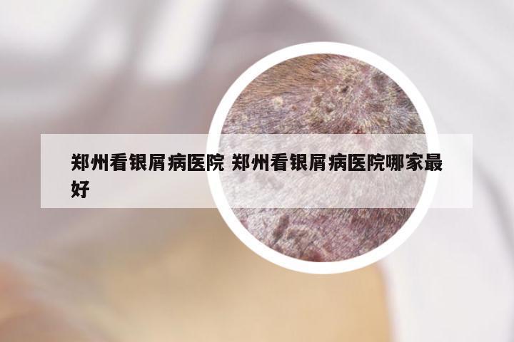 郑州看银屑病医院 郑州看银屑病医院哪家最好
