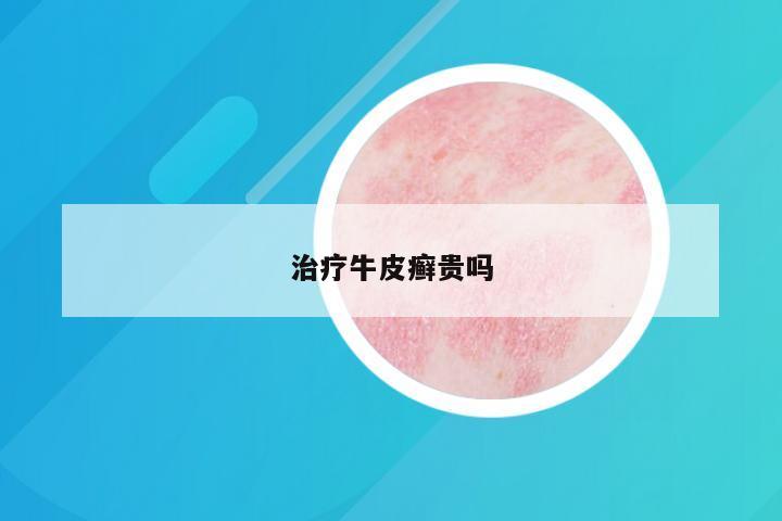 治疗牛皮癣贵吗