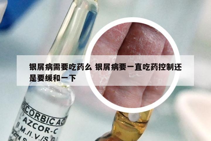 银屑病需要吃药么 银屑病要一直吃药控制还是要缓和一下