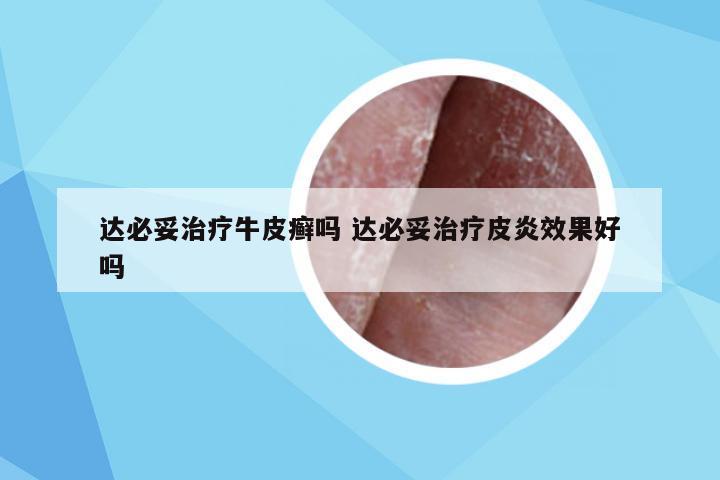 达必妥治疗牛皮癣吗 达必妥治疗皮炎效果好吗