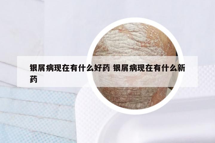 银屑病现在有什么好药 银屑病现在有什么新药