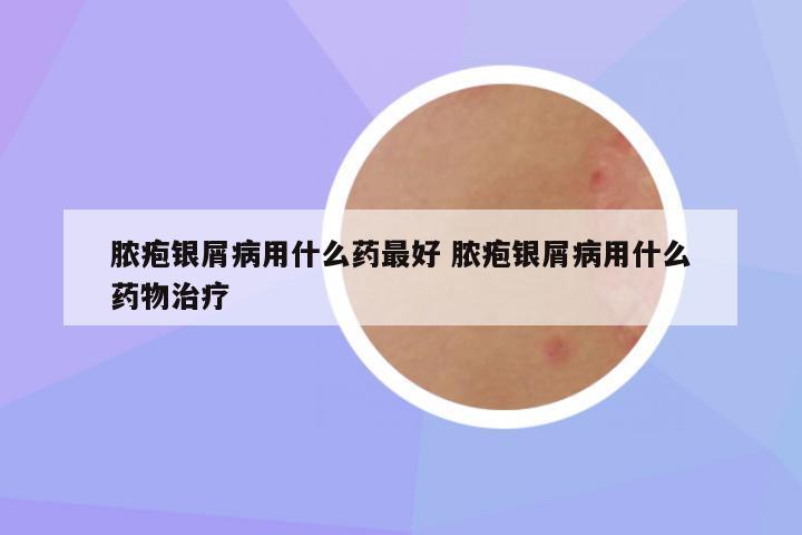 脓疱银屑病用什么药最好 脓疱银屑病用什么药物治疗