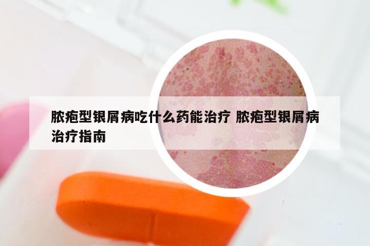 脓疱型银屑病吃什么药能治疗 脓疱型银屑病治疗指南