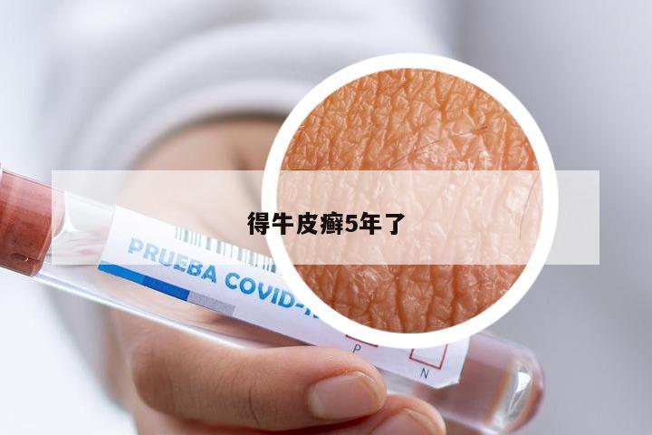得牛皮癣5年了