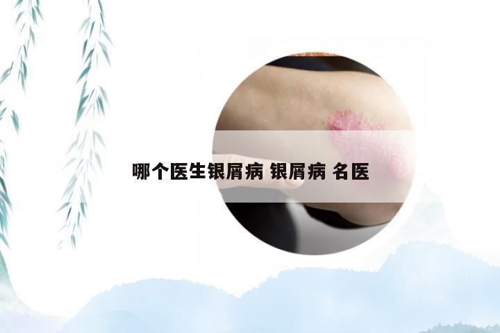 哪个医生银屑病 银屑病 名医