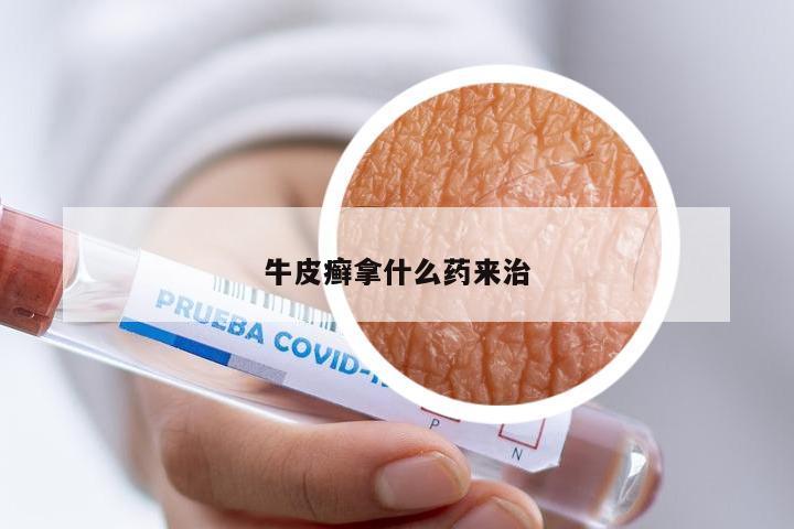 牛皮癣拿什么药来治