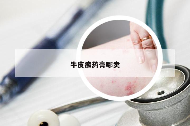 牛皮癣药膏哪卖