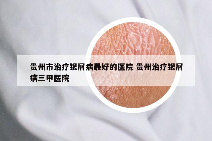 贵州市治疗银屑病最好的医院 贵州治疗银屑病三甲医院