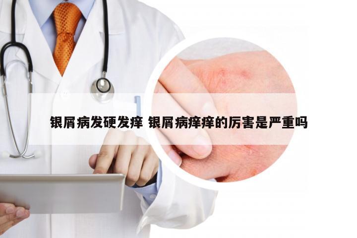 银屑病发硬发痒 银屑病痒痒的厉害是严重吗