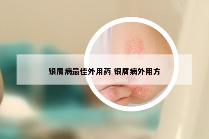 银屑病最佳外用药 银屑病外用方