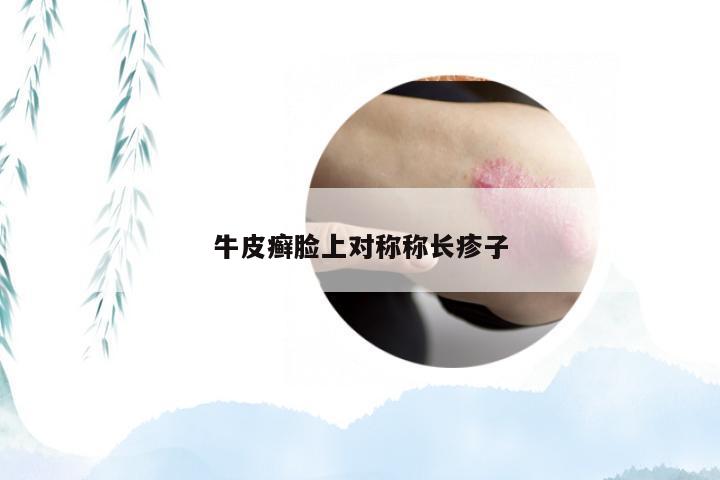 牛皮癣脸上对称称长疹子