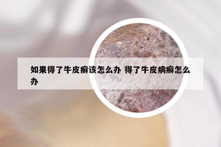 如果得了牛皮癣该怎么办 得了牛皮病癣怎么办