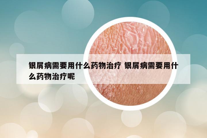 银屑病需要用什么药物治疗 银屑病需要用什么药物治疗呢