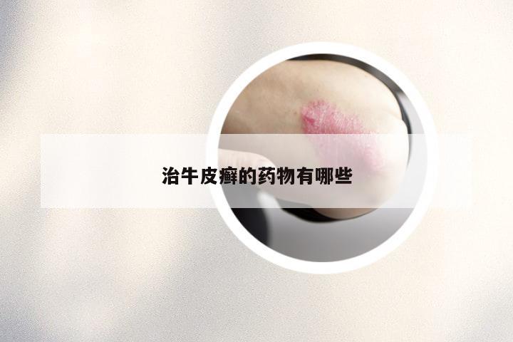治牛皮癣的药物有哪些