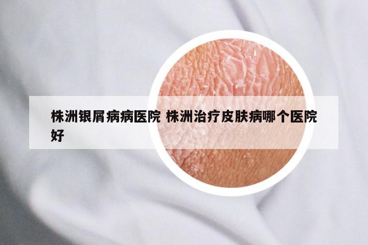 株洲银屑病病医院 株洲治疗皮肤病哪个医院好