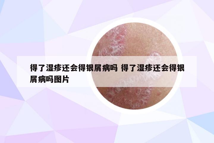 得了湿疹还会得银屑病吗 得了湿疹还会得银屑病吗图片