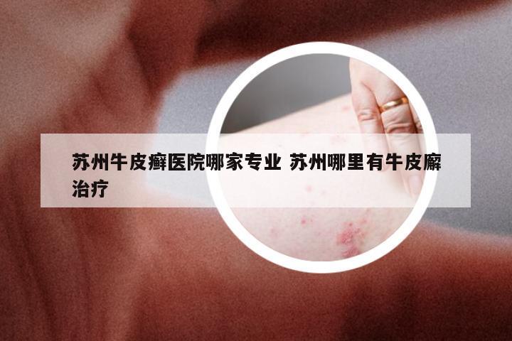 苏州牛皮癣医院哪家专业 苏州哪里有牛皮廨治疗
