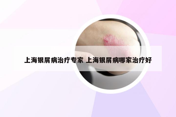 上海银屑病治疗专家 上海银屑病哪家治疗好