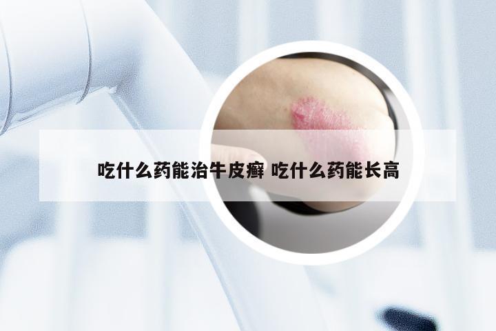 吃什么药能治牛皮癣 吃什么药能长高