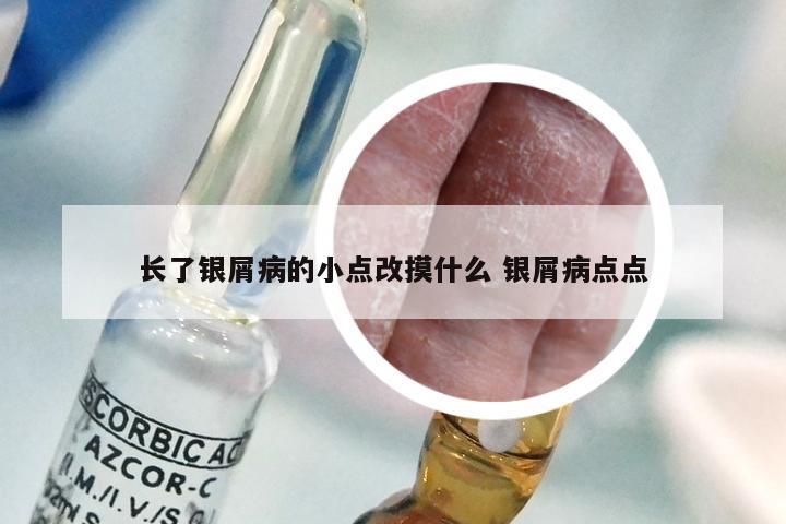长了银屑病的小点改摸什么 银屑病点点