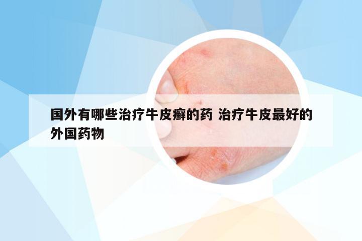 国外有哪些治疗牛皮癣的药 治疗牛皮最好的外国药物