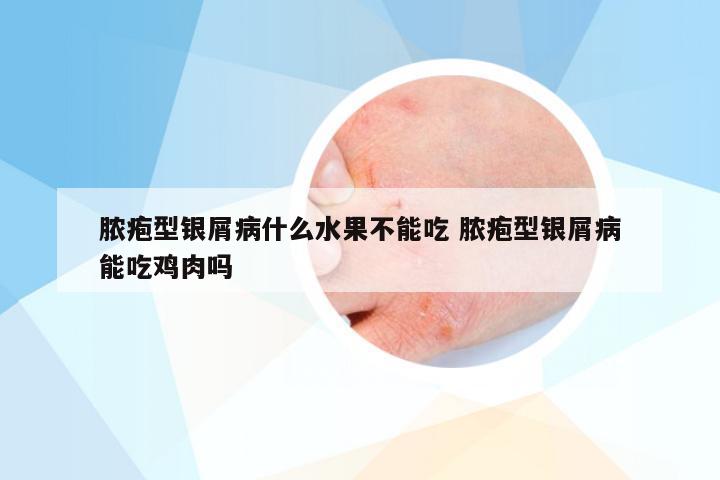 脓疱型银屑病什么水果不能吃 脓疱型银屑病能吃鸡肉吗