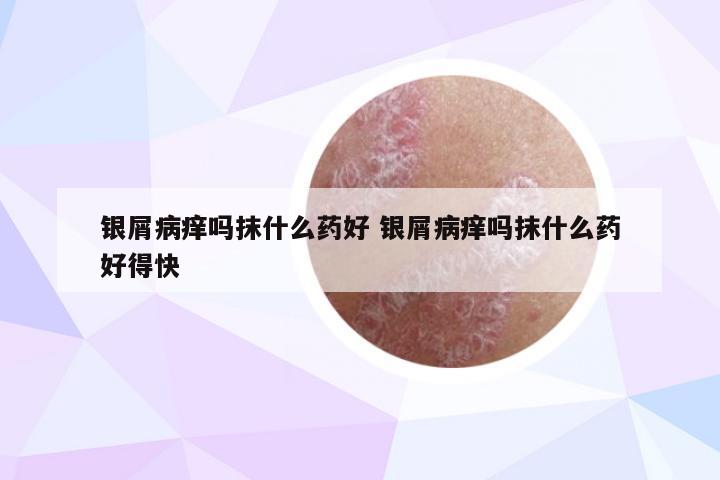 银屑病痒吗抹什么药好 银屑病痒吗抹什么药好得快