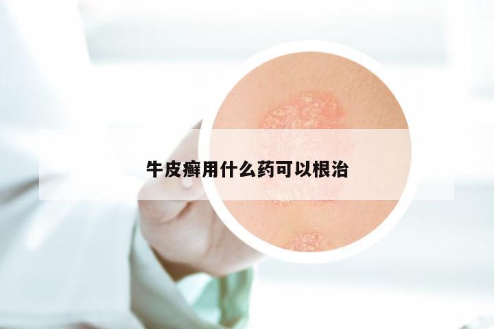 牛皮癣用什么药可以根治