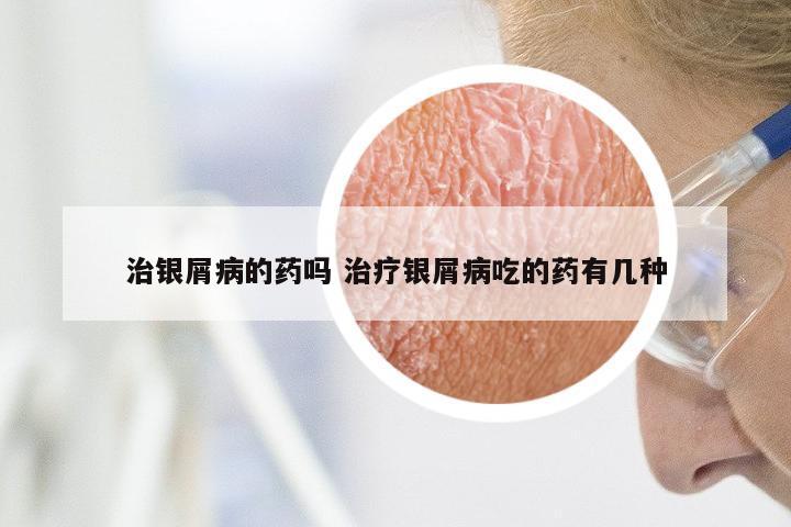 治银屑病的药吗 治疗银屑病吃的药有几种