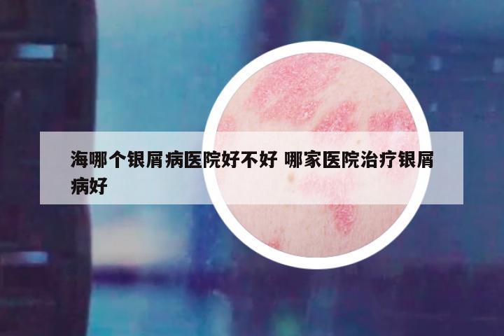 海哪个银屑病医院好不好 哪家医院治疗银屑病好