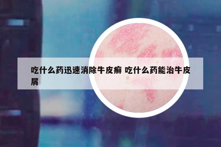 吃什么药迅速消除牛皮癣 吃什么药能治牛皮屑