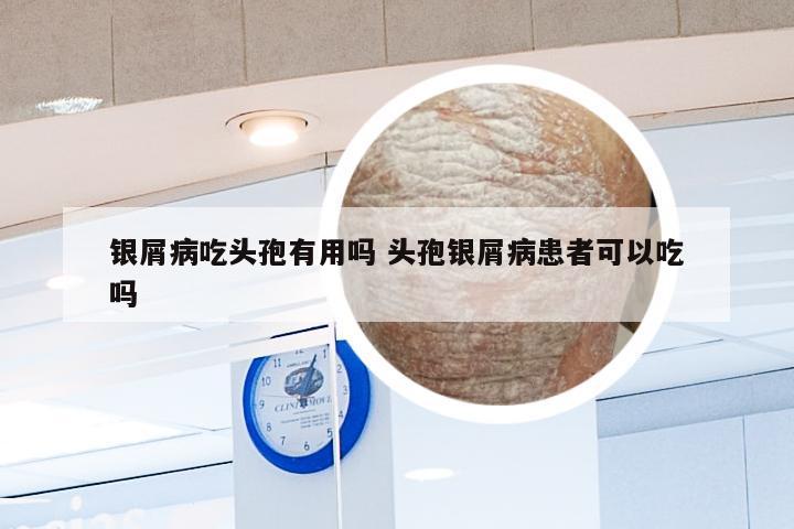 银屑病吃头孢有用吗 头孢银屑病患者可以吃吗