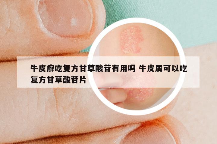 牛皮癣吃复方甘草酸苷有用吗 牛皮屑可以吃复方甘草酸苷片