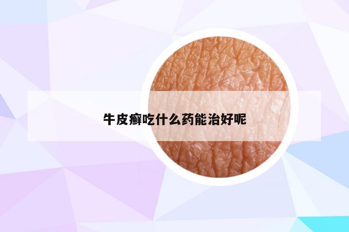 牛皮癣吃什么药能治好呢