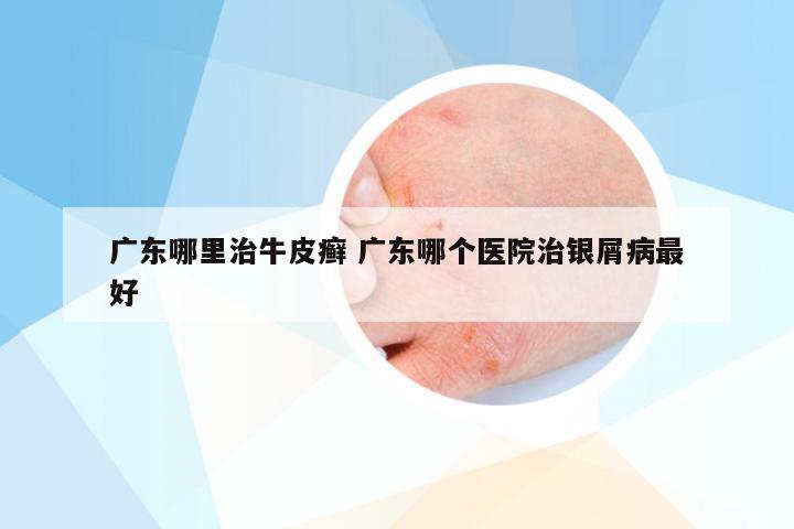 广东哪里治牛皮癣 广东哪个医院治银屑病最好
