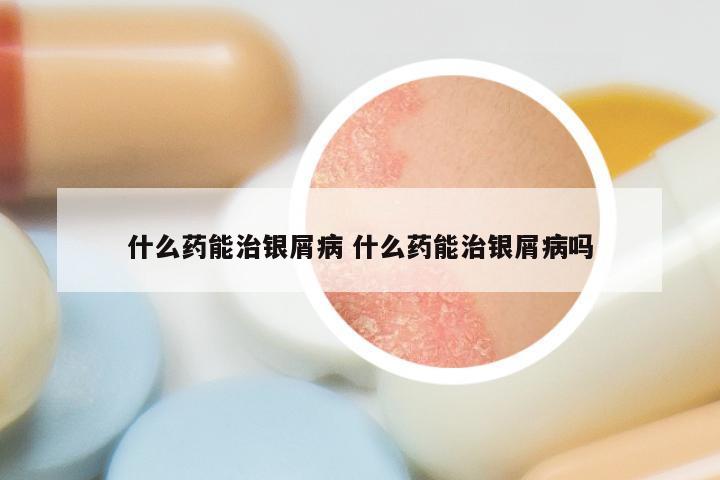 什么药能治银屑病 什么药能治银屑病吗