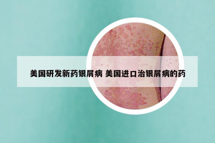 美国研发新药银屑病 美国进口治银屑病的药