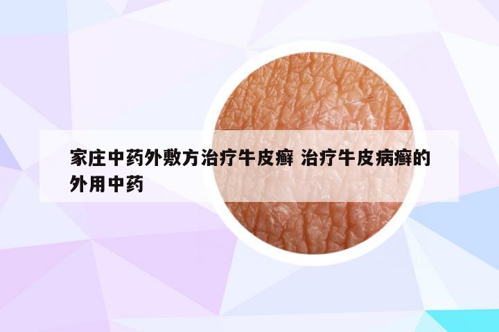 家庄中药外敷方治疗牛皮癣 治疗牛皮病癣的外用中药