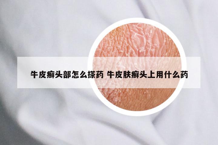 牛皮癣头部怎么搽药 牛皮肤癣头上用什么药