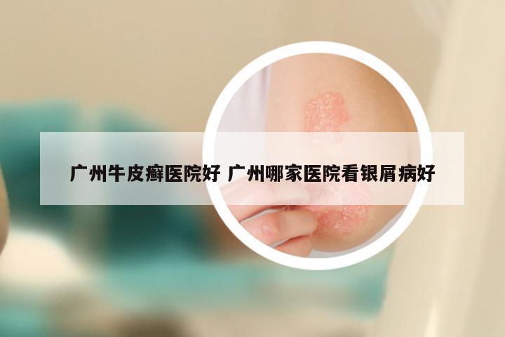 广州牛皮癣医院好 广州哪家医院看银屑病好