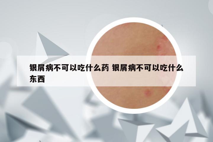 银屑病不可以吃什么药 银屑病不可以吃什么东西