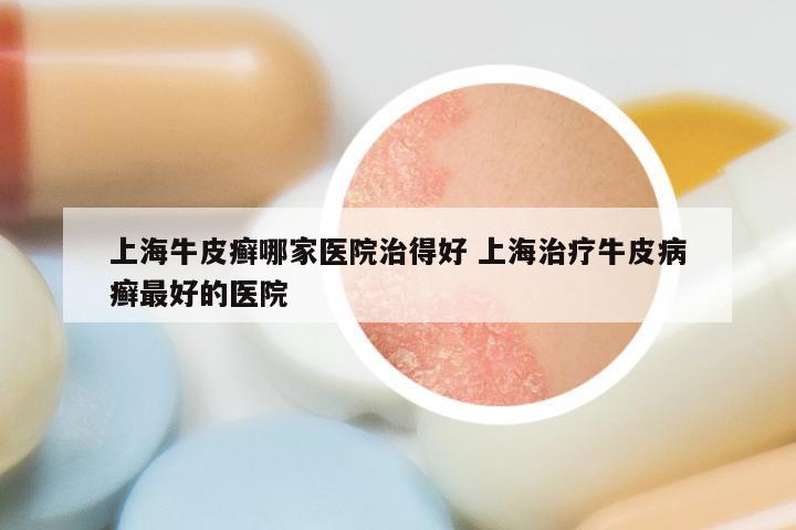 上海牛皮癣哪家医院治得好 上海治疗牛皮病癣最好的医院