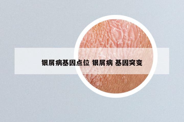 银屑病基因点位 银屑病 基因突变