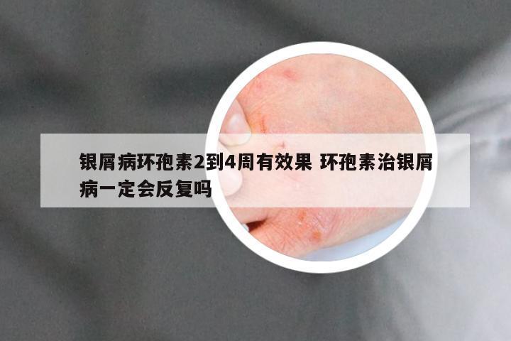 银屑病环孢素2到4周有效果 环孢素治银屑病一定会反复吗