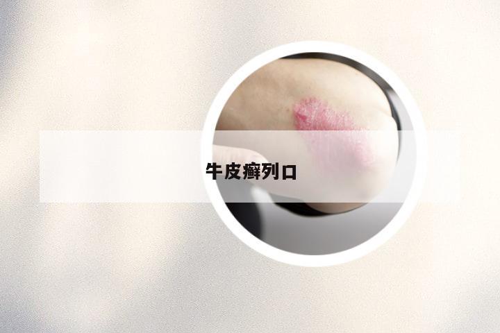 牛皮癣列口