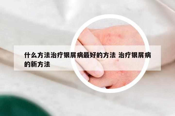 什么方法治疗银屑病最好的方法 治疗银屑病的新方法