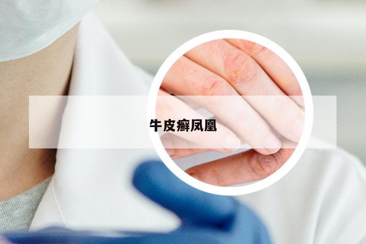 牛皮癣凤凰