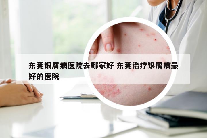 东莞银屑病医院去哪家好 东莞治疗银屑病最好的医院