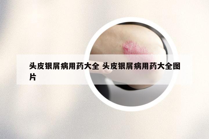 头皮银屑病用药大全 头皮银屑病用药大全图片