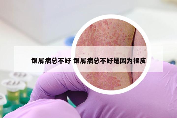 银屑病总不好 银屑病总不好是因为抠皮